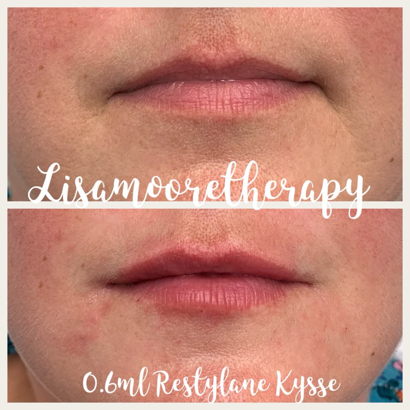 Before and after — Lip enhancement at Lisa Moore Therapy