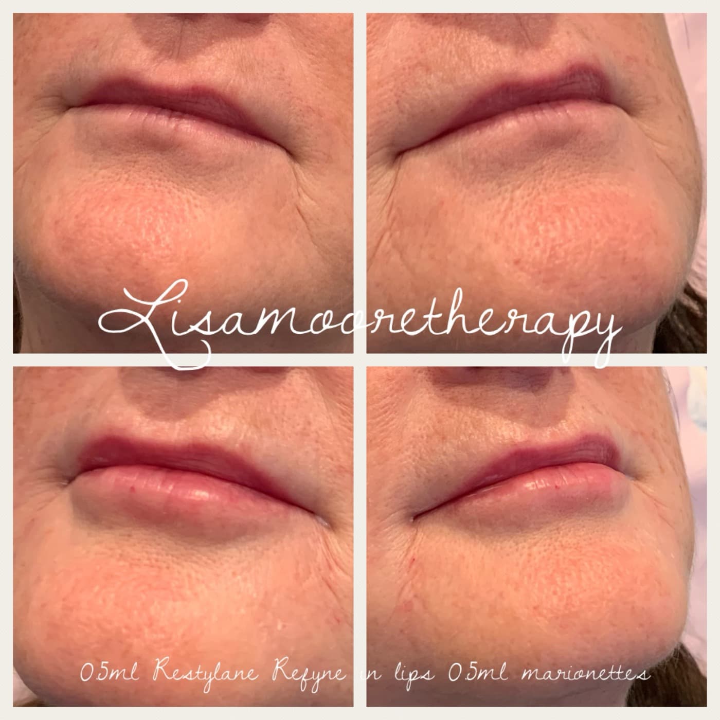 Before and after — Lip enhancement at Lisa Moore Therapy