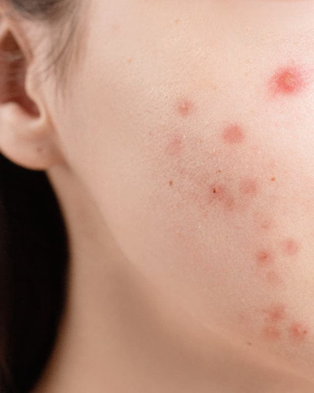 Close-up of a cheek with small red blemishes